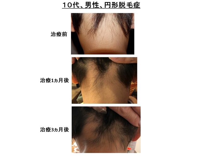 円形脱毛症　病院